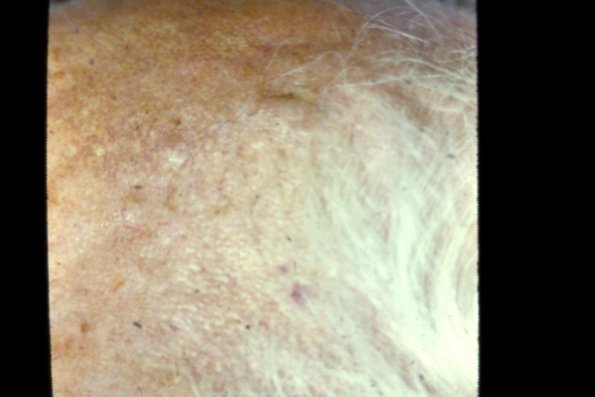 Seborrheic Wart