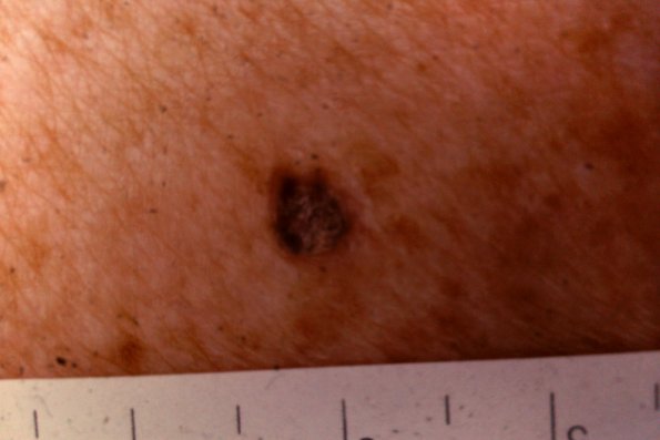 Seborrhic Keratosis