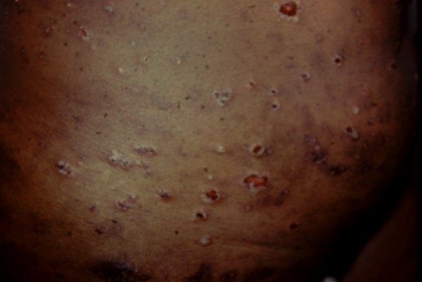 Subcorneal Pustular Dermatosis (14)