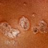 Subcorneal Pustular Dermatosis (2)
