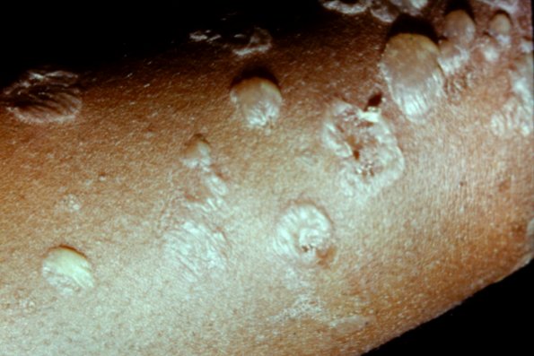 Subcorneal Pustular Dermatosis (3)