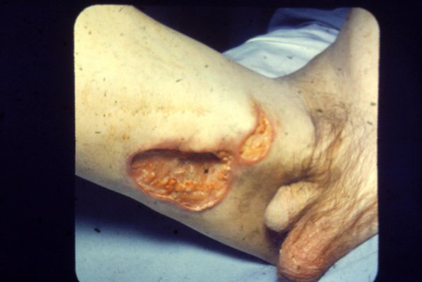 Sporotrichosis (15)