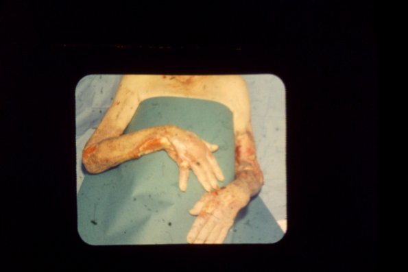 Sporotrichosis (18)