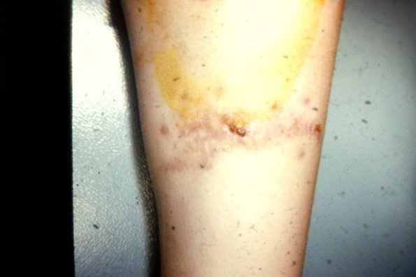 Sporotrichosis (19)