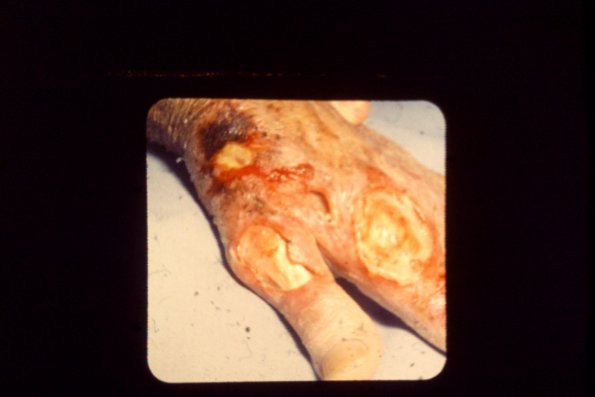 Sporotrichosis (21)