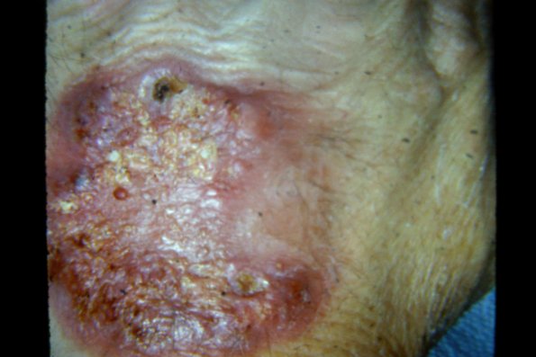 Sporotrichosis (27)