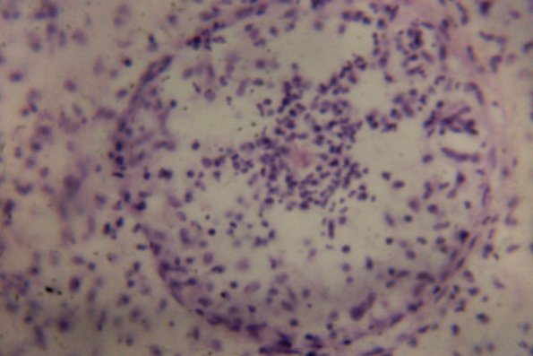 Sporotrichosis (29)