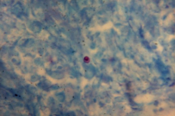 Sporotrichosis (33)