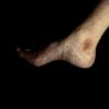 Stasis Dermatitis (3)