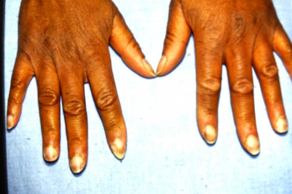 Raynauld's Syndrome