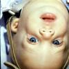 Treacher-Collins Syndrome (2)