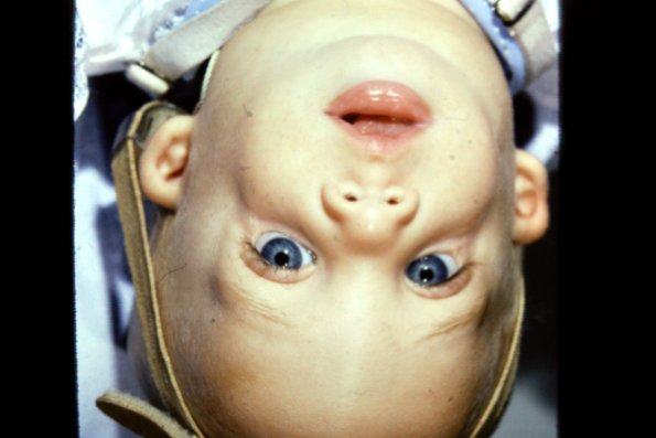 Treacher-Collins Syndrome (2)