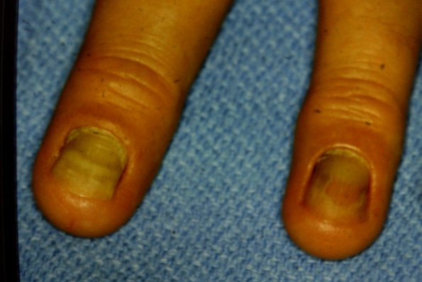 Yellow Nail Syndrome