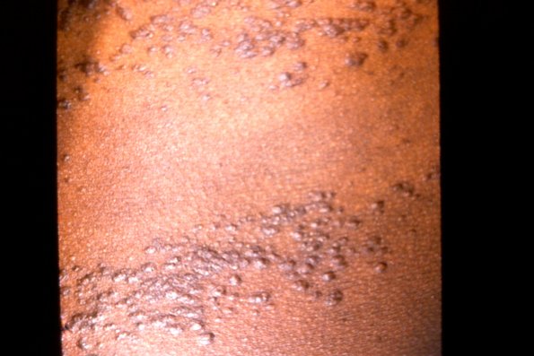 Eruptive Syringoma