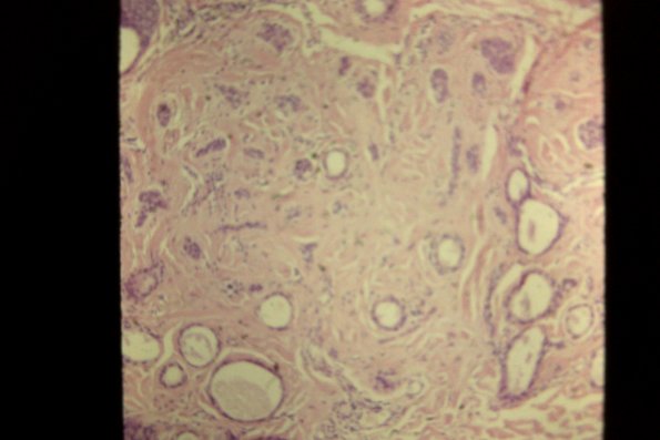 Syringoma (24)