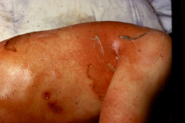 Toxic Epidermal Necrolysis (4)