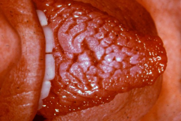 Scrotal Tongue (2)