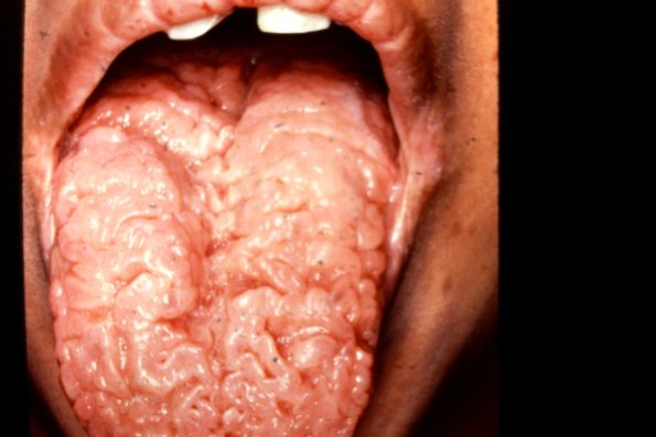 Scrotal Tongue (3)