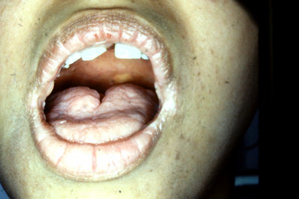 Scrotal Tongue