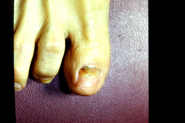 Toenail Trauma