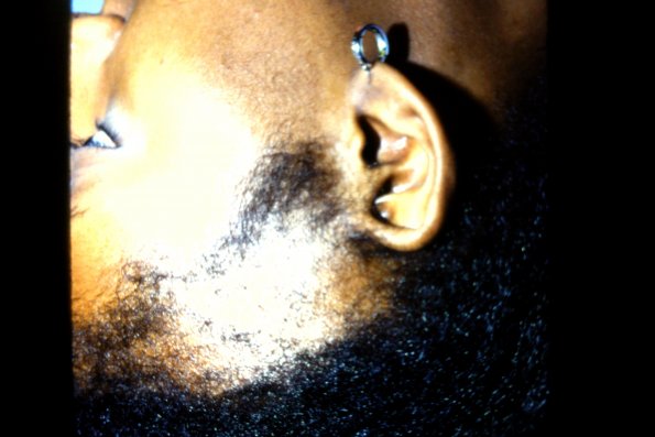 Traction Alopecia Vs Trichotillomania