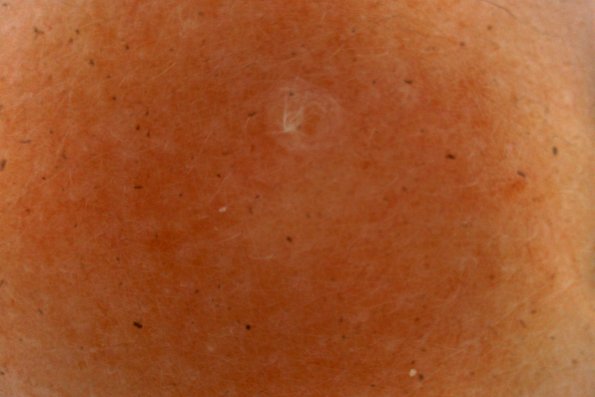 Trichofolliculoma (2)