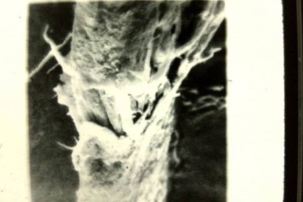 Trichorrhexis Nodosa (5)