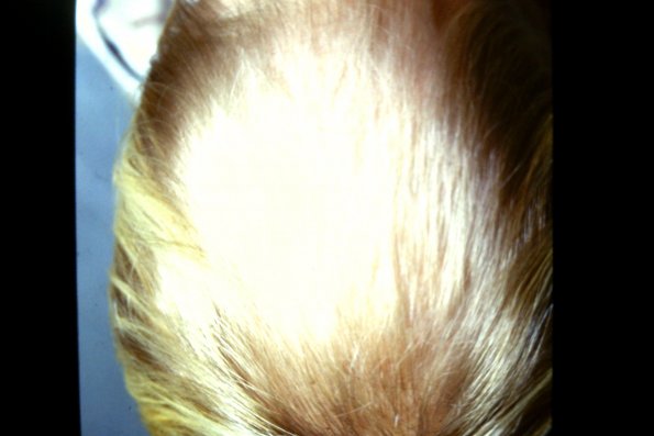 Trichotillomania (2)