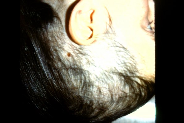 Trichotillomania (4)