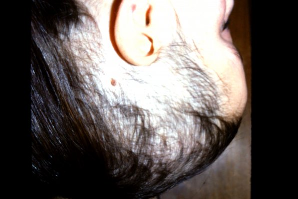 Trichotillomania (6)