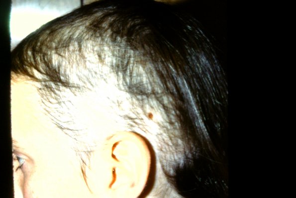 Trichotillomania (9)