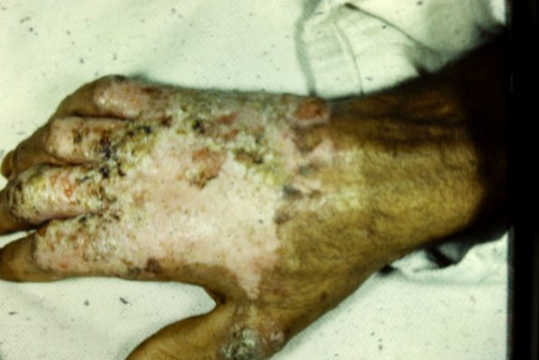 Tuberculosis (6)