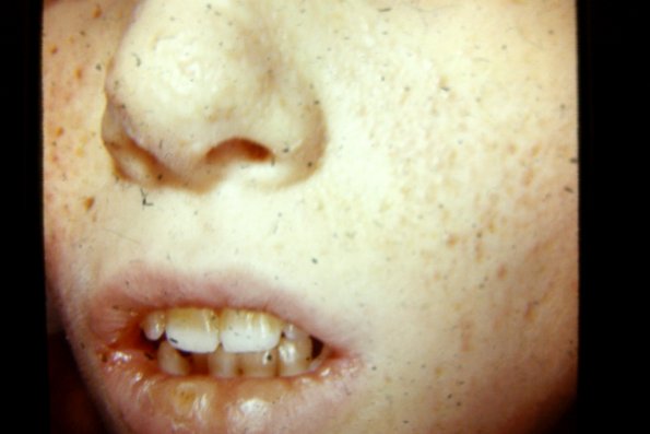 Tuberous Sclerosis (11)