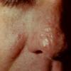 Tuberous Sclerosis Pringle Type Fibrous Papules of Nose