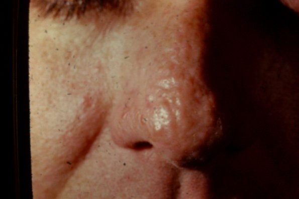 Tuberous Sclerosis Pringle Type Fibrous Papules of Nose