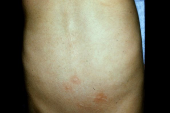 Urticaria Pigmentosa (4)