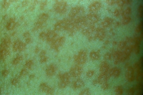 Atypical Urticaria
