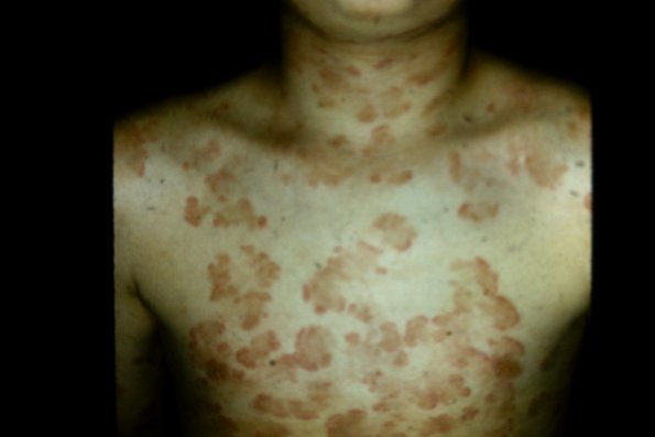 Chronic Urticaria