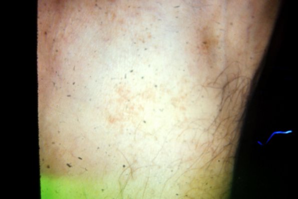 Papular Urticaria (4)