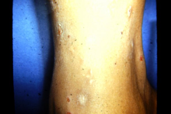 Papular Urticaria (5)