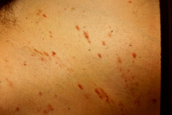 Papular Urticaria