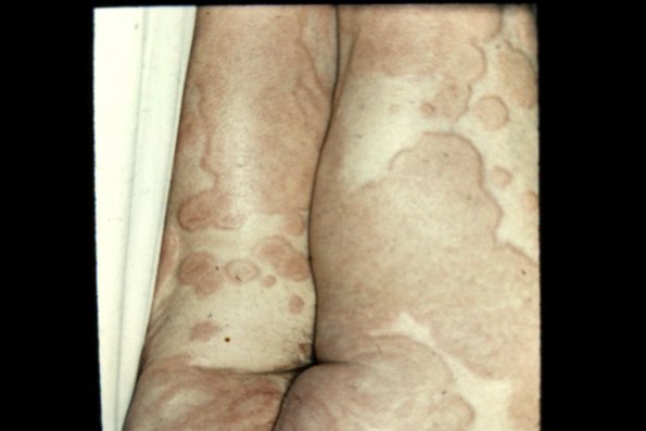 Urticaria (2)