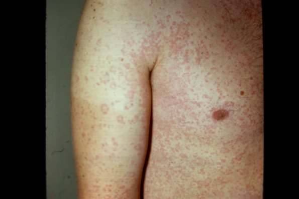 Urticaria Diuril