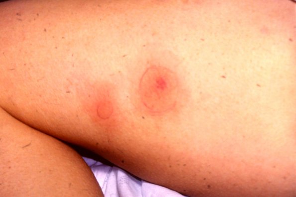 Nodular Vasculitis (2)