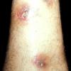 Nodular Vasculitis