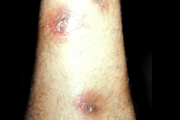 Nodular Vasculitis