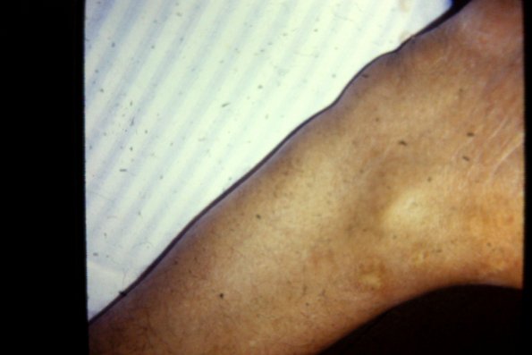 Xanthoma tendineum