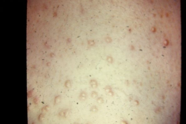 Eruptive Xanthoma