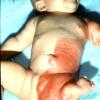 Infant Child Dystrophy