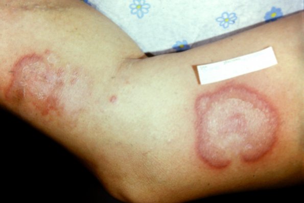 Cutaneous crohns